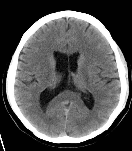 File:Acoustic schwannoma (Radiopaedia 33045-34065 Axial non-contrast 15).png