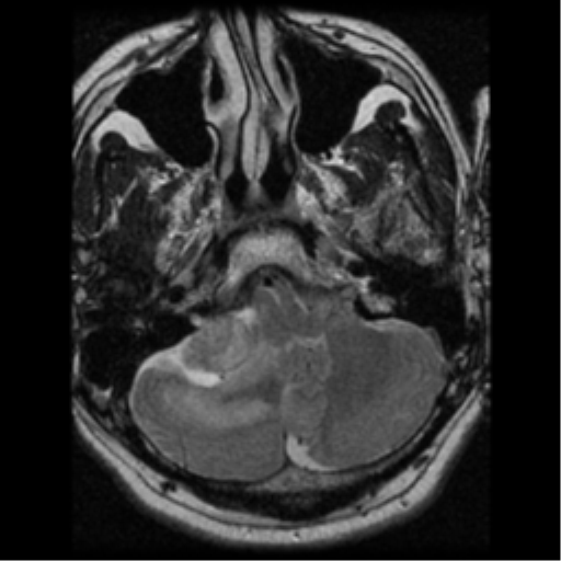 File:Acoustic schwannoma (Radiopaedia 39170-41387 Axial T2 6).png