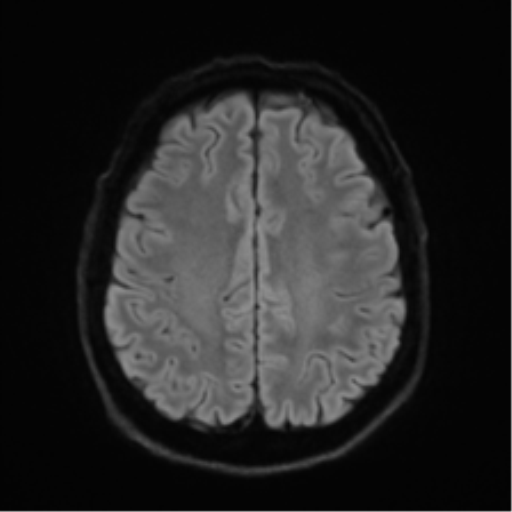 Acoustic schwannoma (Radiopaedia 50846-56358 Axial DWI 49).png