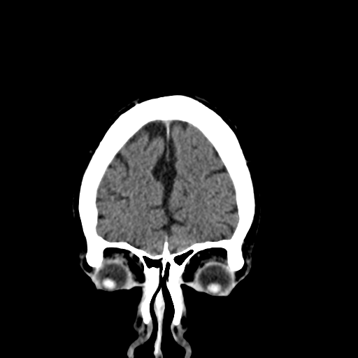 File:Acoustic schwannoma (Radiopaedia 55729-62280 Coronal non-contrast 8).png