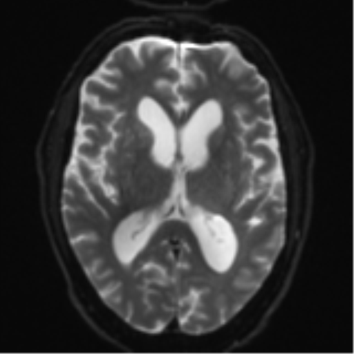 Acoustic schwannoma (Radiopaedia 55729-62281 E 14).png