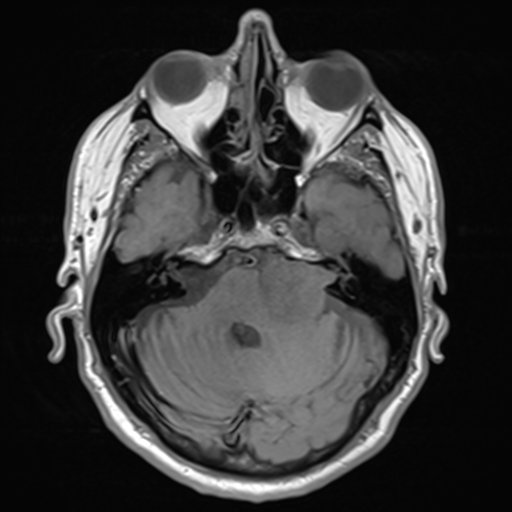 File:Acoustic schwannoma (Radiopaedia 55729-62281 T1 8).png