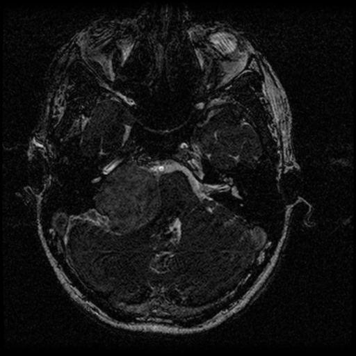 Acoustic schwannoma - eroding petrous apex (Radiopaedia 39674-42004 Axial T2 32).png