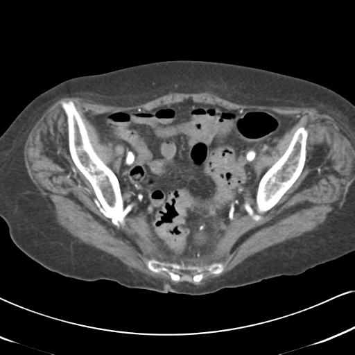 File:Active bleeding from duodenal ulcer with embolization (Radiopaedia 34216-35481 Axial C+ arterial phase 54).png