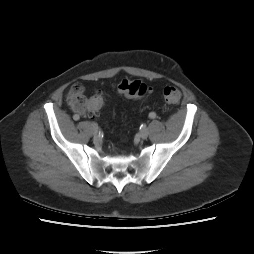 File:Active colonic bleed on CT (Radiopaedia 49765-55025 Axial C+ delayed 65).jpg
