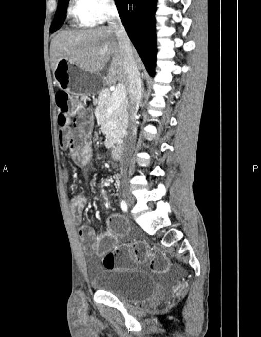Active crohn disease (Radiopaedia 87133-103397 Sagittal C+ arterial phase 38).jpg