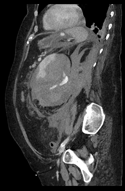 Active renal extravasation with large subcapsular and retroperitoneal hemorrhage (Radiopaedia 60975-68796 Sagittal C+ portal venous phase 83).jpg