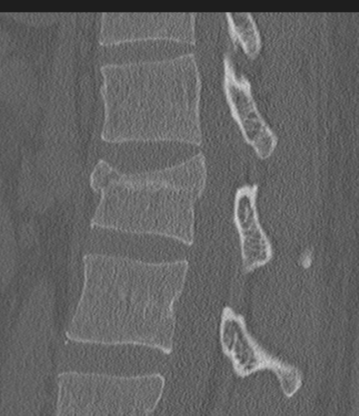 File:Acute L1 burst compression fracture (Radiopaedia 34430-35755 Sagittal bone window 37).png