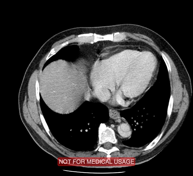 Acute aortic dissection - Stanford type A (Radiopaedia 40661-43285 Axial C+ portal venous phase 44).jpg