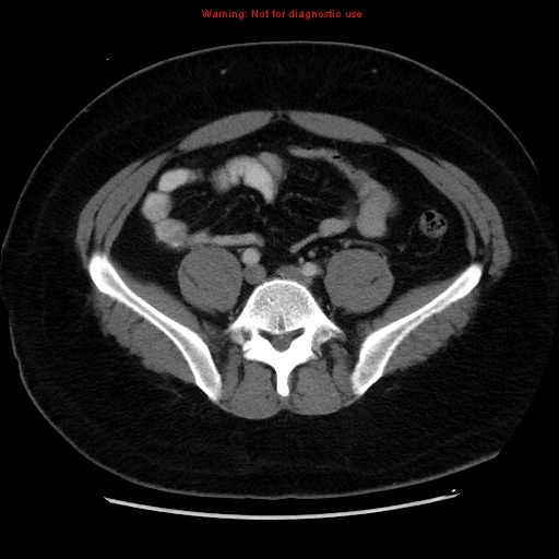 File:Acute appendicitis (Radiopaedia 12326-12607 Axial C+ portal venous phase 27).jpg