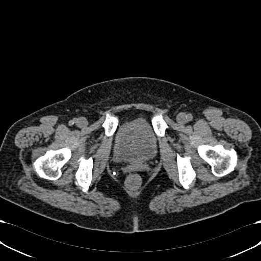 Acute appendicitis (Radiopaedia 58627-65818 Axial non-contrast 87).jpg