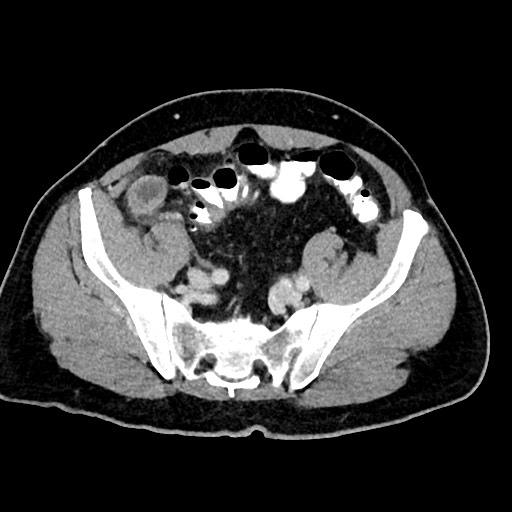 Acute appendicitis (Radiopaedia 77016-88960 Axial C+ portal venous phase 111).jpg