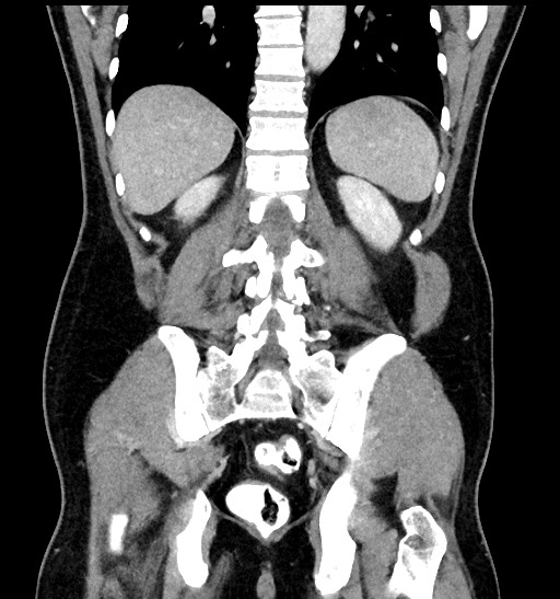 Acute appendicitis (Radiopaedia 77016-88960 Coronal C+ portal venous phase 72).jpg