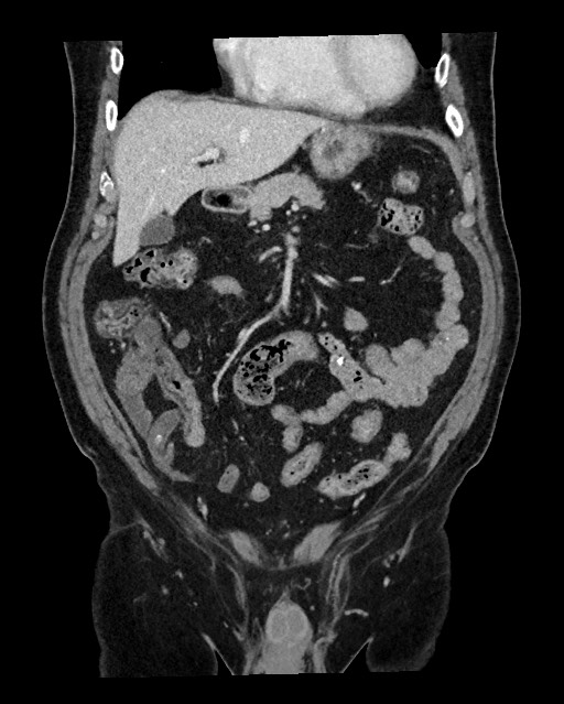 Acute appendicitis - large appendicoliths (Radiopaedia 61805-69820 Coronal C+ portal venous phase 45).jpg