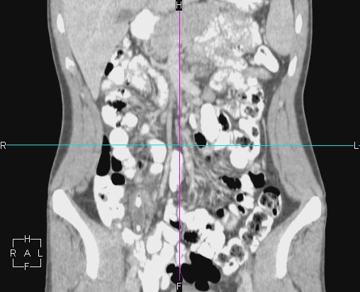 File:Acute appendicitis with CT arrowhead sign (Radiopaedia 21474-21411 Coronal C+ portal venous phase 6).JPG