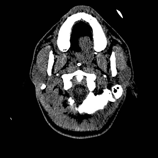Acute basilar artery occlusion (Radiopaedia 43582-46985 Axial non-contrast 22).jpg