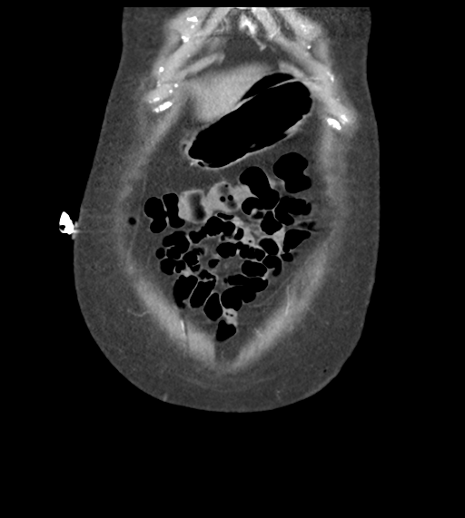 Acute bleed from gastric fundus biopsy site (Radiopaedia 35201-36737 D 11).png