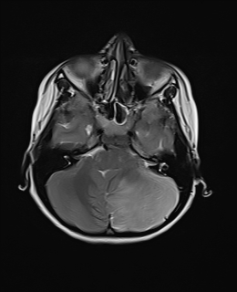 File:Acute cerebellar ataxia (Radiopaedia 61487-69446 Axial T2 5).jpg
