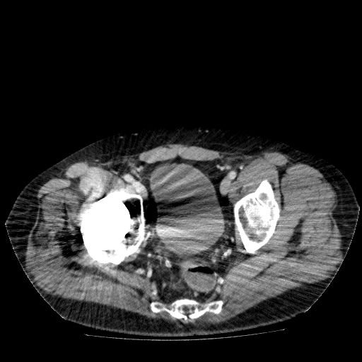 Acute cholecystitis and incidental left sided IVC (Radiopaedia 49352-54459 Axial C+ portal venous phase 139).jpg