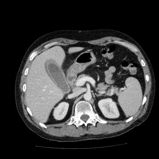 File:Acute cholecystitis and incidental left sided IVC (Radiopaedia 49352-54459 Axial C+ portal venous phase 53).jpg