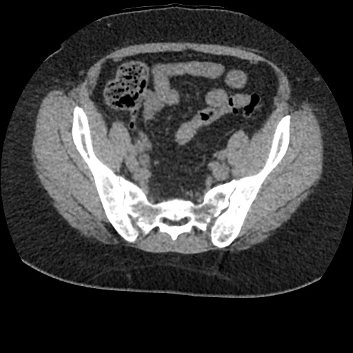 Acute cholecystitis and ureteric colic (Radiopaedia 42330-45444 Axial prone 84).jpg