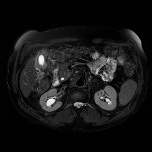 File:Acute cholecystitis complicated by pylephlebitis (Radiopaedia 65782-74915 Axial T2 fat sat 26).jpg