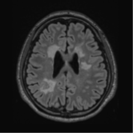 Acute disseminated encephalomyelitis (ADEM)- Anti-NMDA receptor encephalitis (Radiopaedia 54920-61201 Axial FLAIR 46).png