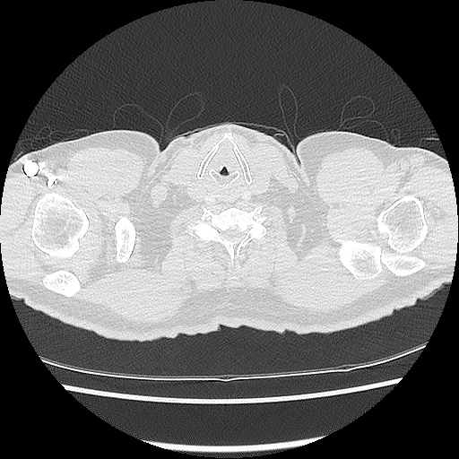 File:Acute epicardial fat necrosis (Radiopaedia 42327-45440 Axial lung window 1).jpg