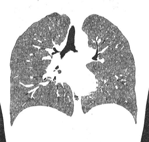 Acute hypersensitivity pneumonitis (Radiopaedia 85293-100870 Coronal lung window 70).jpg