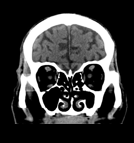 Acute left anterior cerebral artery territory infarction (Radiopaedia 51785-57578 Coronal non-contrast 13).jpg