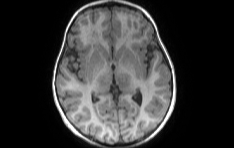 File:Acute necrotizing encephalitis of childhood (Radiopaedia 67356-76737 Axial T1 48).jpg