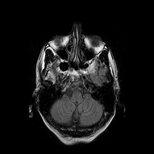 File:Acute necrotizing toxoplasma encephalitis (Radiopaedia 10683-11149 Axial FLAIR 15).jpg