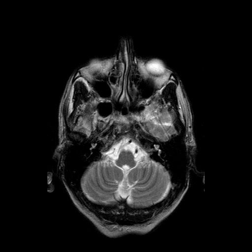 File:Acute necrotizing toxoplasma encephalitis (Radiopaedia 10683-11149 Axial T2 15).jpg