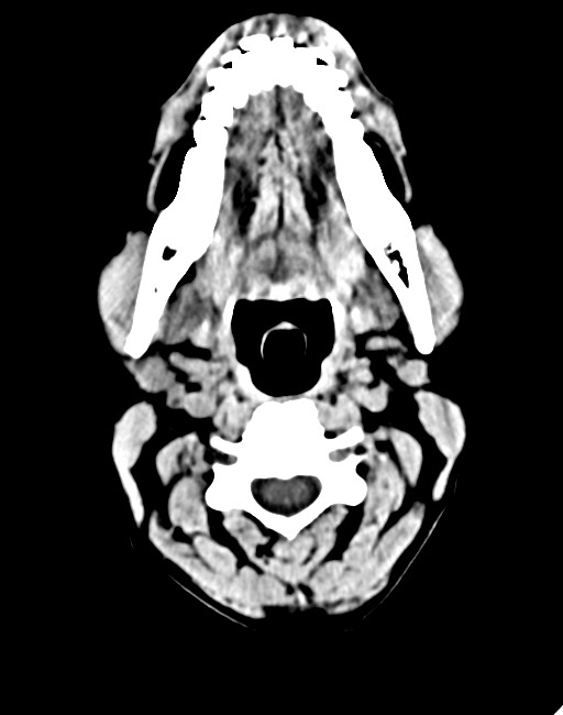 Acute on chronic subdural hematoma (Radiopaedia 74814-85823 Axial non-contrast 11).jpg