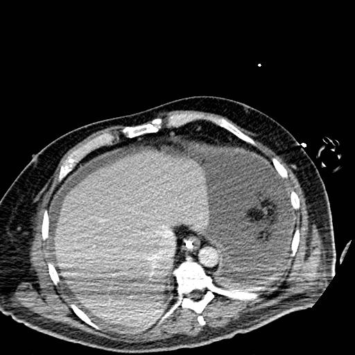 File:Acute pancreatic necrosis (Radiopaedia 13560-18501 Axial C+ portal venous phase 10).jpg