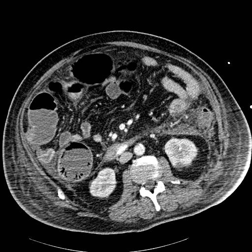 Acute pancreatic necrosis (Radiopaedia 13560-18502 Axial C+ portal venous phase 51).jpg