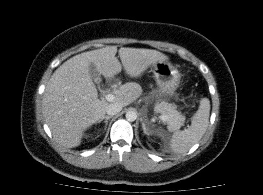 File:Acute pancreatitis (Radiopaedia 69236-79012 Axial C+ portal venous phase 27).jpg
