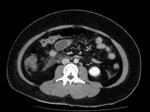Acute pancreatitis (Radiopaedia 69236-79012 Axial C+ portal venous phase 50).jpg
