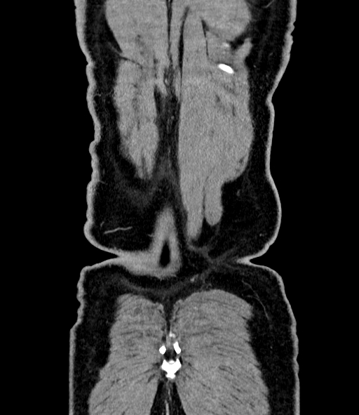 Acute pancreatitis (Radiopaedia 87428-103757 Coronal C+ portal venous phase 89).jpg