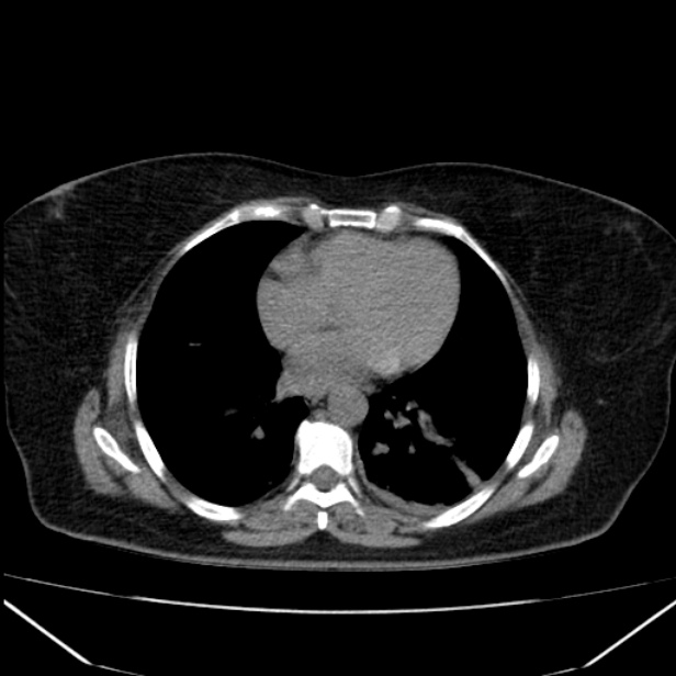 Acute pancreatitis - Balthazar C (Radiopaedia 26569-26714 Axial non-contrast 8).jpg
