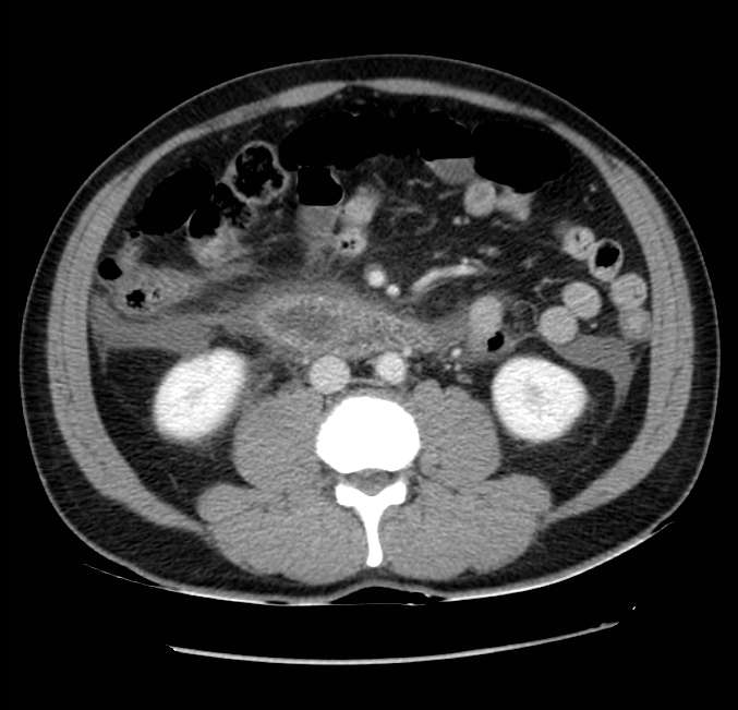 Acute pancreatitis - Balthazar E (Radiopaedia 23080-23110 Axial C+ portal venous phase 36).jpg