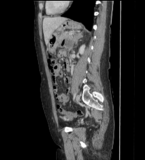 File:Acute pancreatitis - Balthazar E - post ERCP (Radiopaedia 27562-27772 Sagittal C+ portal venous phase 86).png