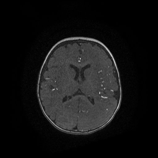 Acute phase of hemiconvulsion-hemiplegia epilepsy syndrome (Radiopaedia 29309-29745 Axial TOF angiography 39).jpg