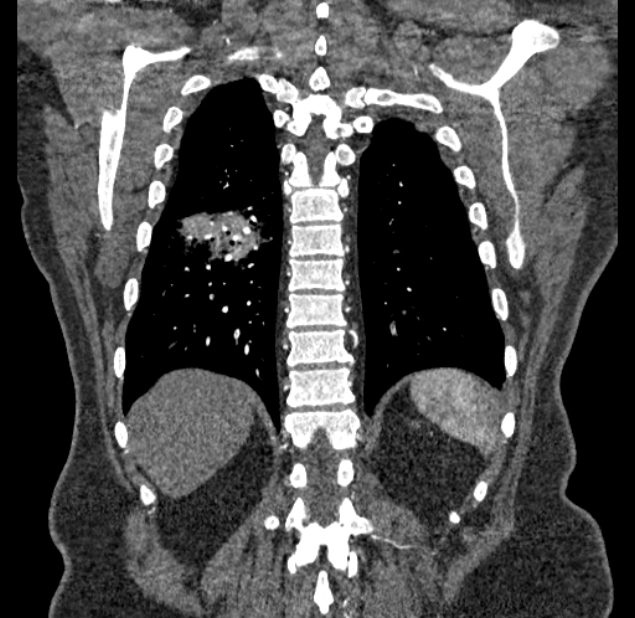 Acute pulmonary embolism with pulmonary infarcts (Radiopaedia 77688-89908 Coronal C+ CTPA 84).jpg