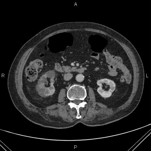 File:Acute renal artery occlusion (Radiopaedia 86586-102682 Axial C+ portal venous phase 39).jpg
