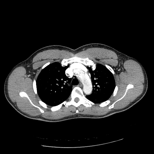 File:Acute segmental pulmonary emboli and pulmonary infarction (Radiopaedia 62264-70444 Axial C+ CTPA 37).jpg