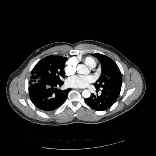 Acute segmental pulmonary emboli and pulmonary infarction (Radiopaedia 62264-70444 Axial C+ CTPA 64).jpg