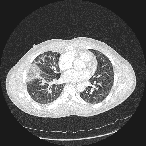 Acute segmental pulmonary emboli and pulmonary infarction (Radiopaedia 62264-70444 Axial lung window 109).jpg