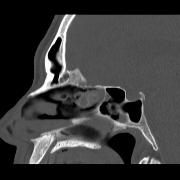 Acute sinusitis (Radiopaedia 23161-23215 Sagittal bone window 33).jpg