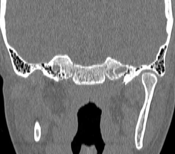 Acute sinusitis (Radiopaedia 40564-43158 Coronal bone window 52).jpg